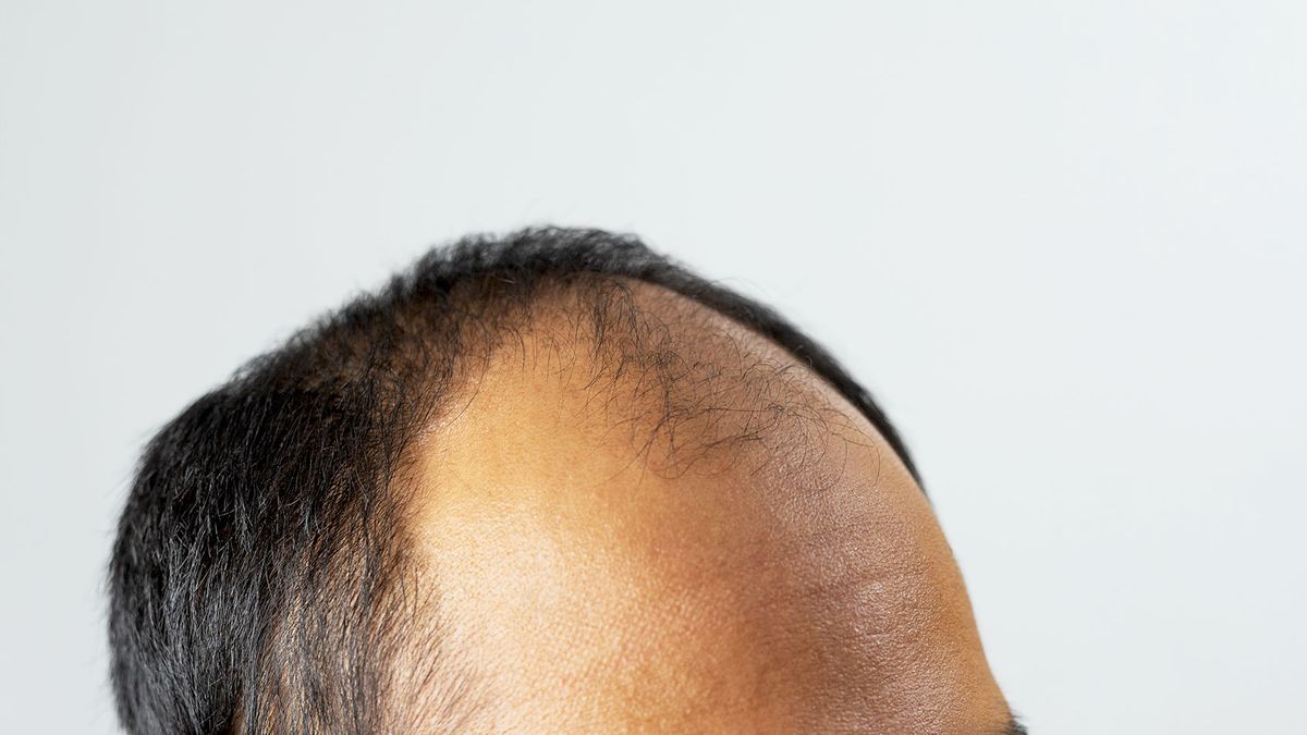 Horseshoes and widow's peaks: Why do men go bald in different patterns? |  