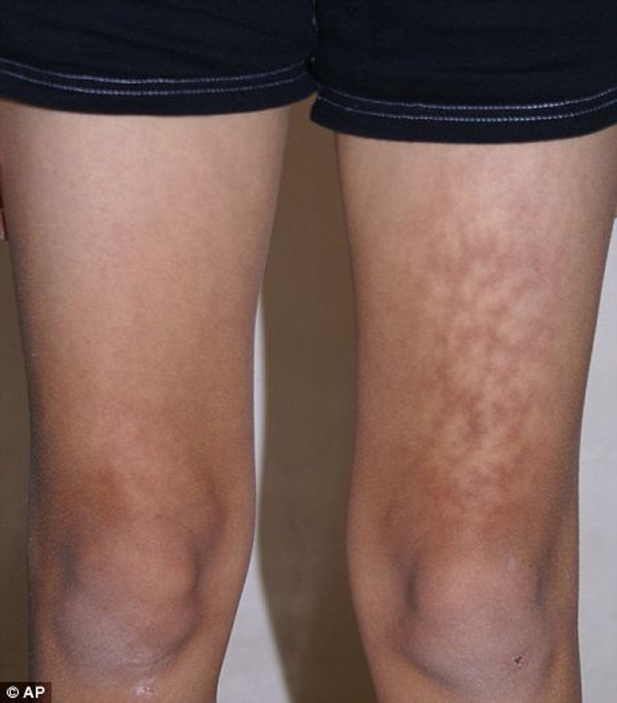 "Toasted Skin Syndrome" (© Ap)