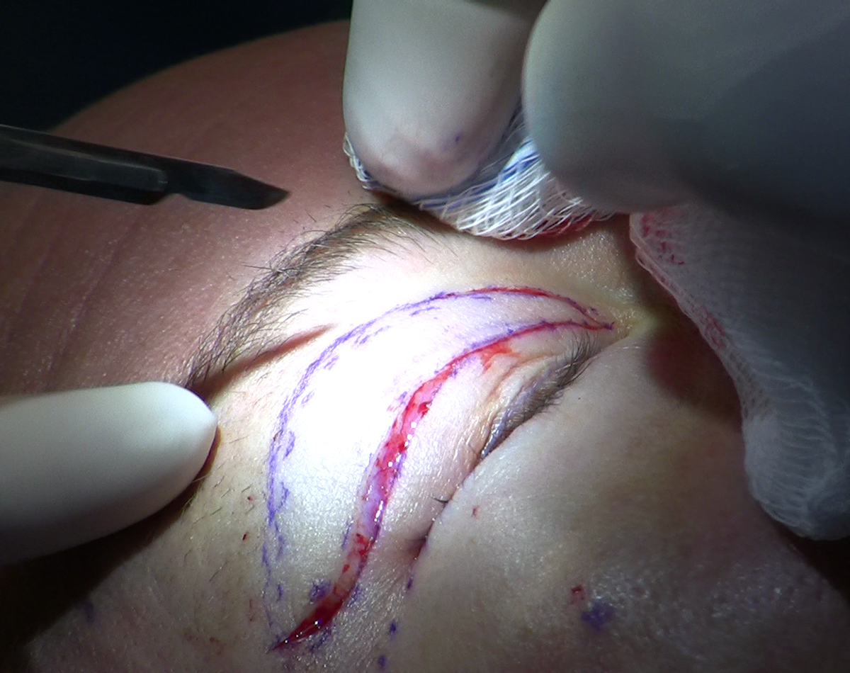 A surgeon begins a upper-eyelid blepharoplasty/Wikimedia Commons