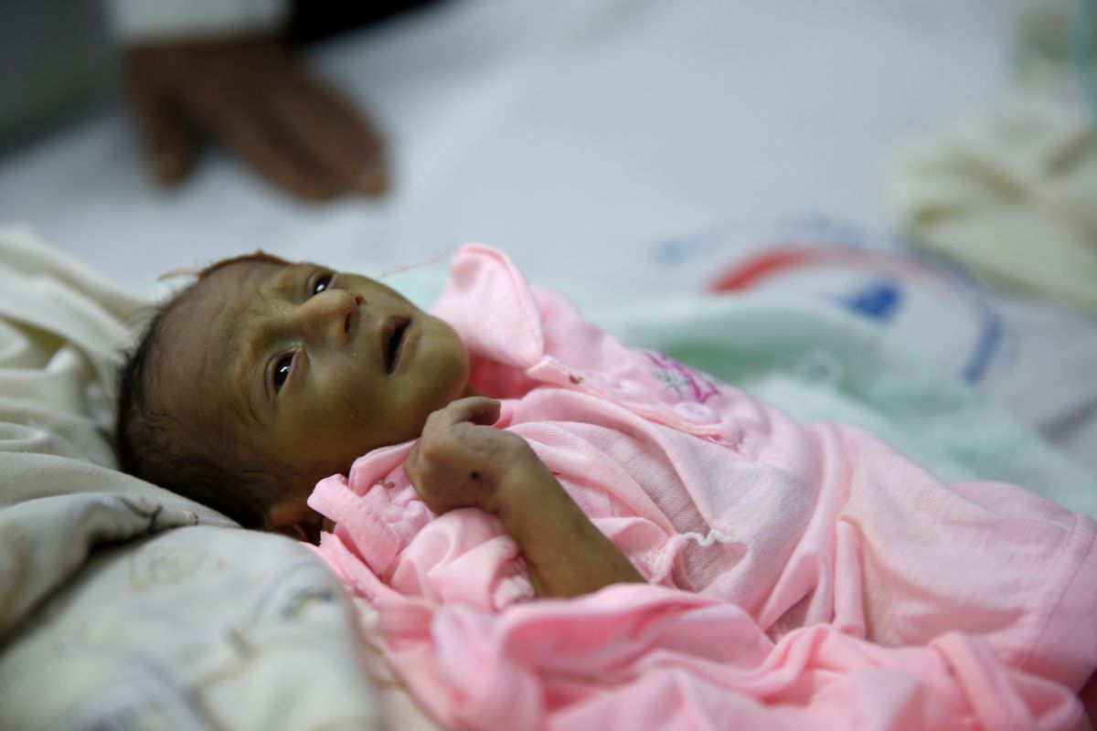 In this Jan. 24, 2016 photo, a malnourished child lies in a bed at a therapeutic feeding center in a hospital in Sanaa, Yemen. Some 3 million children here under five years require services to treat or prevent malnutrition, according to a UNICEF report on Jan. 13. (AP Photo/Hani Mohammed) (AP)