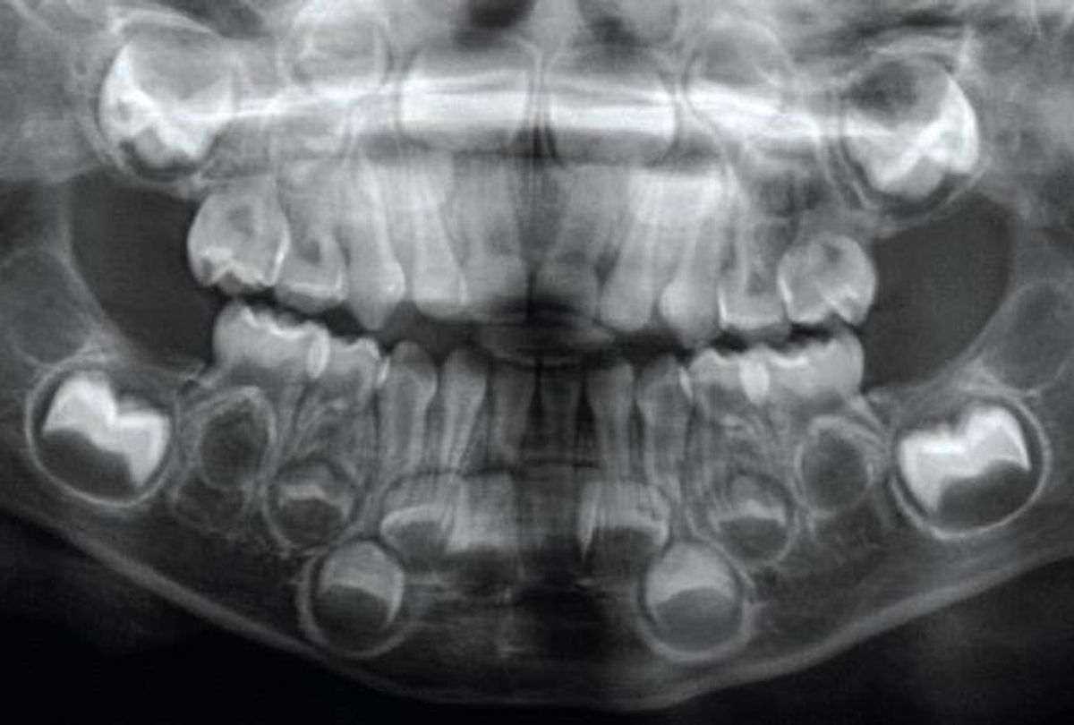 Dental X-ray of child's mouth.  (Courtesy of Masrour Makaremi / MIT Press Reader)