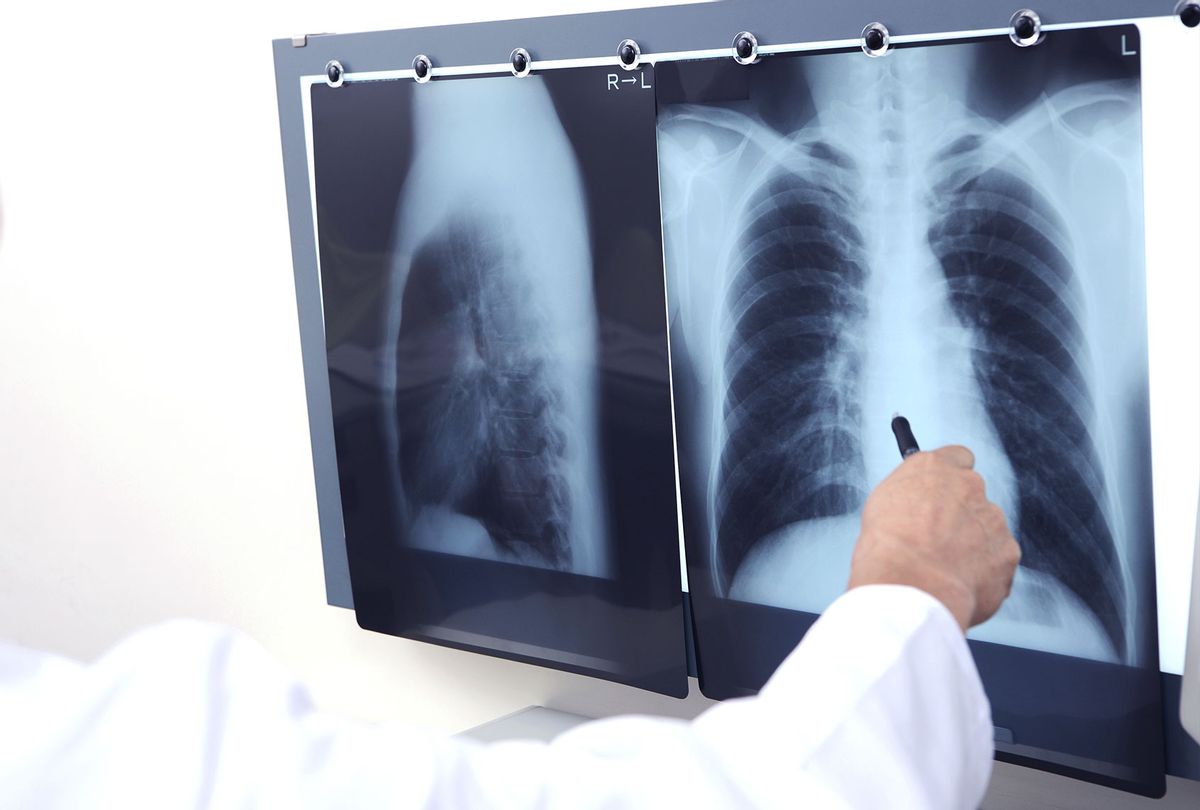 Chest X-Ray (Getty Images/Fotosearch)