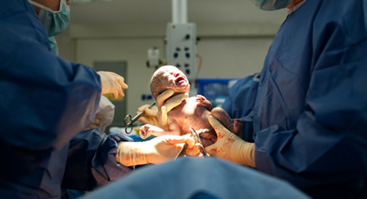 Baby being born via Caesarean Section coming out