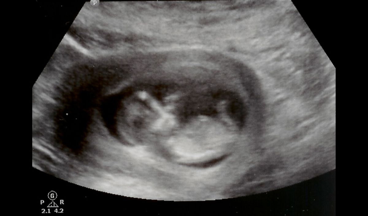 A 12-week ultrasound image from birthornot.com