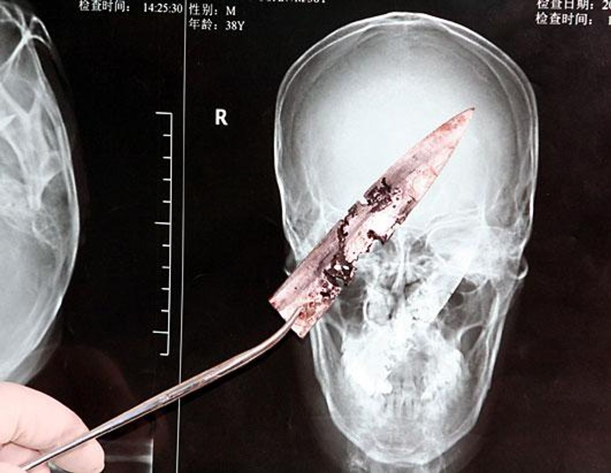 X-ray of Li Fu's head