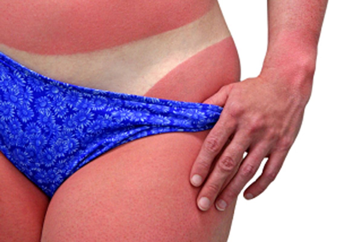 A woman's body with a bad case of sunburn. Isolated on white background and includes clipping path.