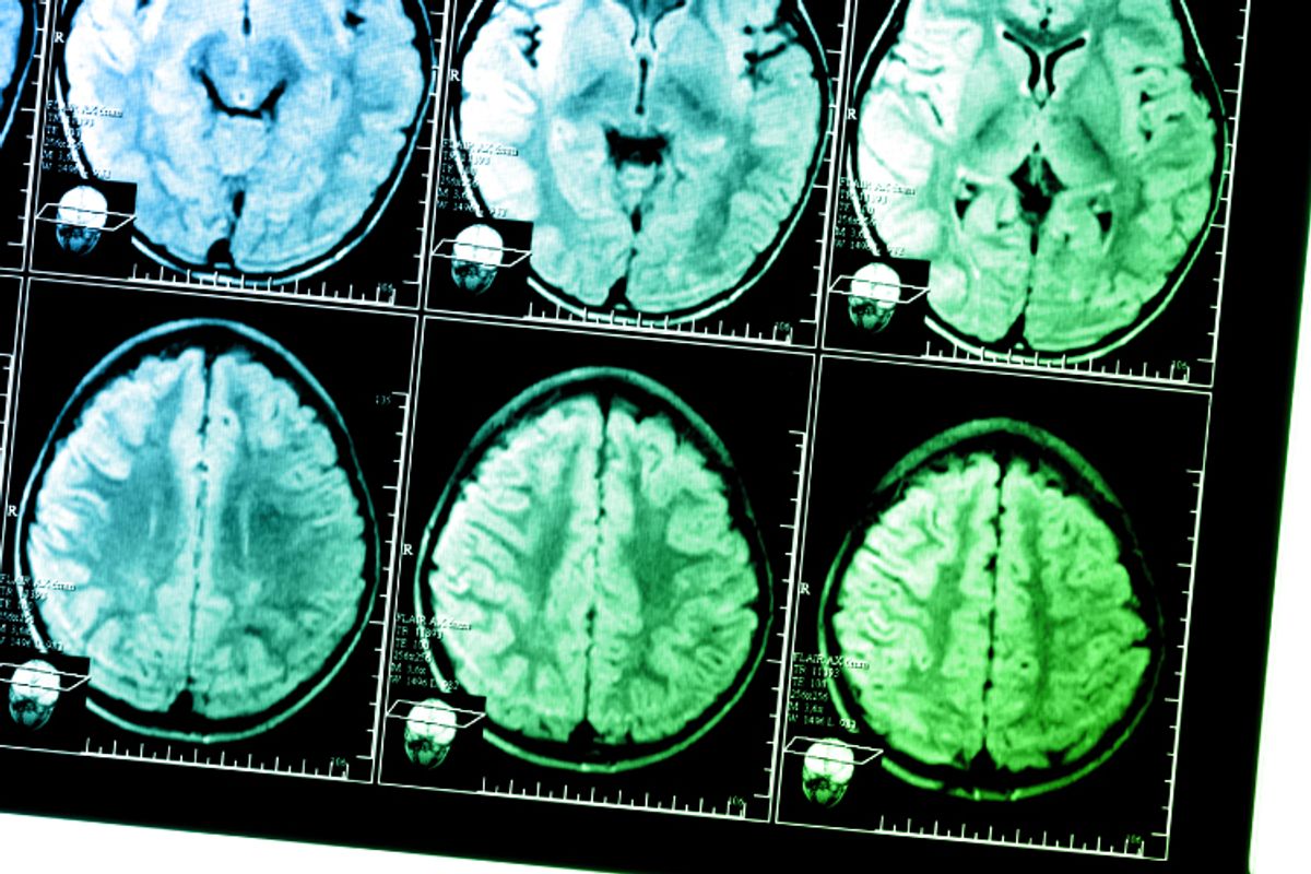 Largest Brain Study of 62,454 Scans Identifies Drivers of Brain