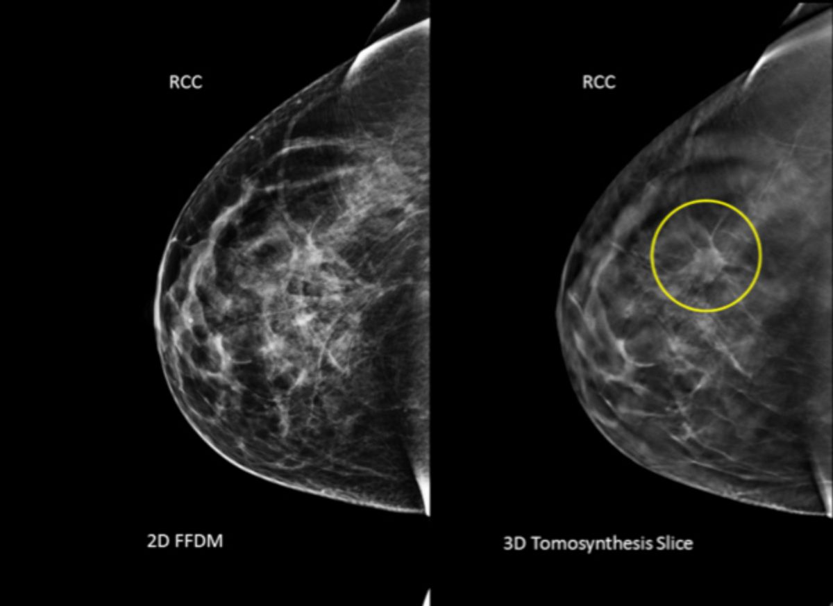This undated combination provided by Hologic shows an image taken using conventional mammography, left, and an image using a 3D mammography, right, with a tumor circled that wasnt visible on the first image. A large study that was published Tuesday, June 24, 2014, in the Journal of the American Medical Association found that adding breast screening with 3D imaging to conventional digital mammograms is slightly better at finding cancer than regular scans alone, with fewer false alarms. (AP Photo/Courtesy Hologic) (AP)
