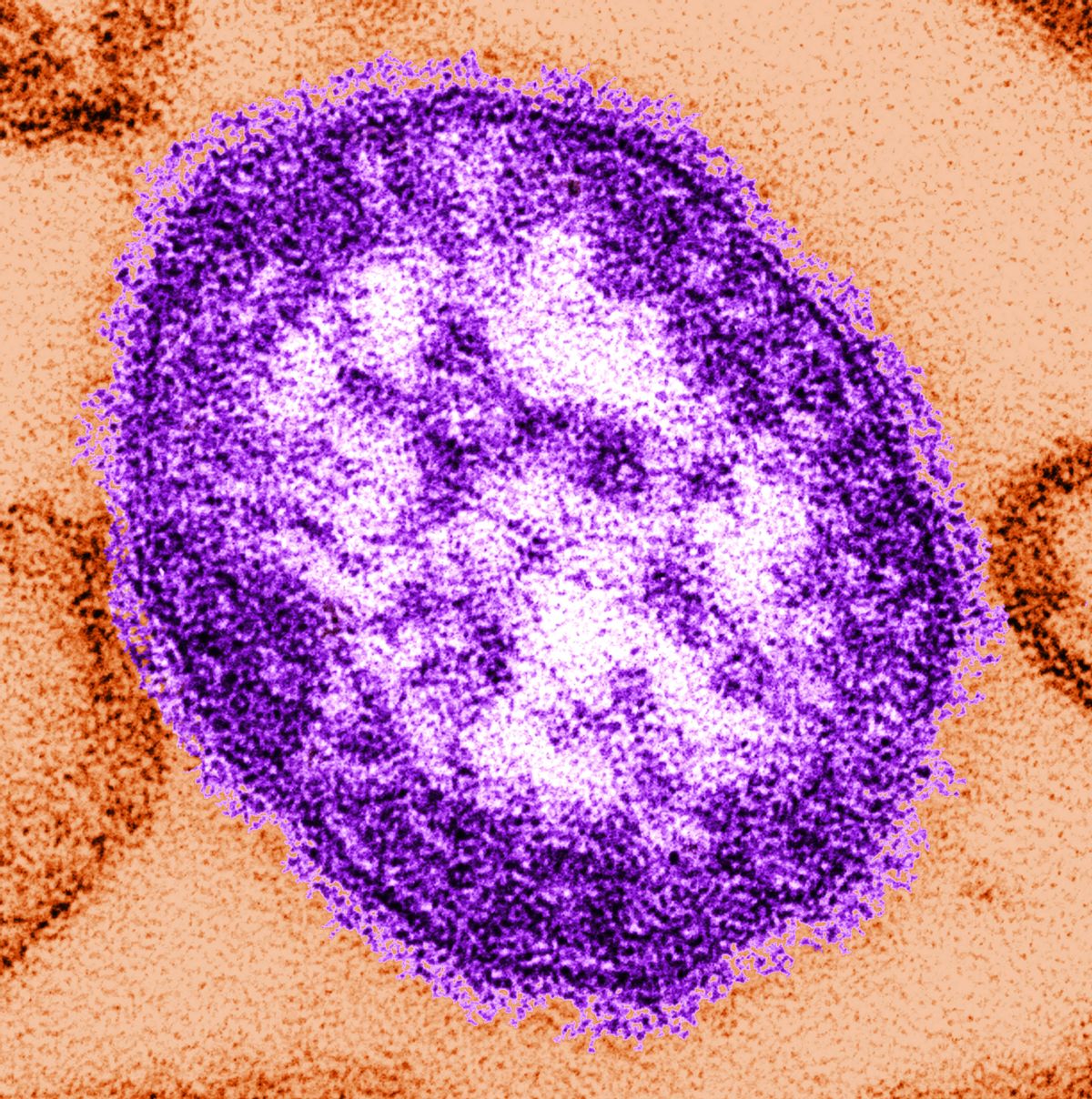 This undated image made available by the Centers for Disease Control and Prevention on Feb. 4, 2015 shows an electron microscope image of a measles virus particle, center. Measles is considered one of the most infectious diseases known. The virus is spread through the air when someone infected coughs or sneezes. (AP Photo/Centers for Disease Control and Prevention, Cynthia Goldsmith) (AP)