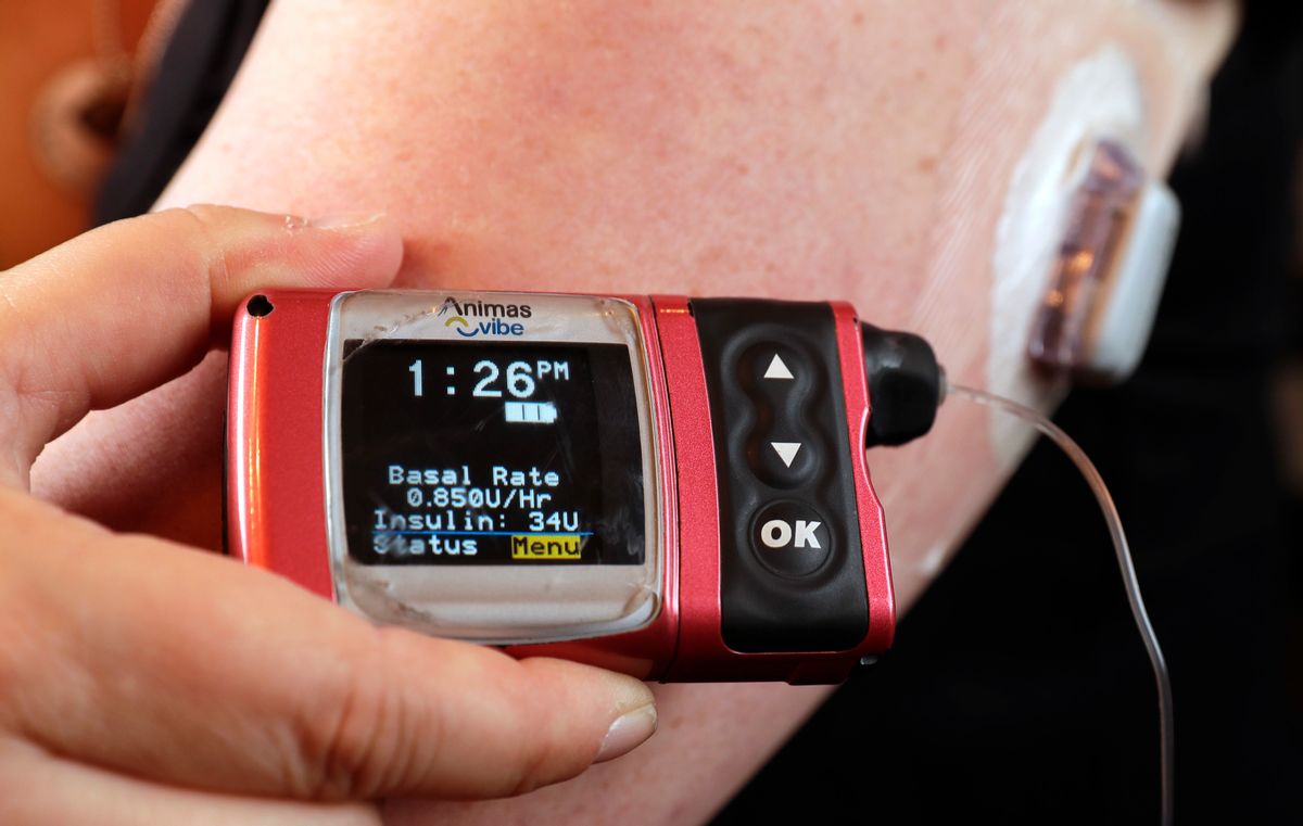 In this Tuesday, June 7, 2016, photo, Stephanie Rodenberg-Lewis holds her Animas Corp. insulin pump at her home in Katy, Texas. Her insurance company, UnitedHealth Group Inc., has made a deal with device maker Medtronic that will slash options for diabetics who use the wearable pumps which cost thousands of dollars. (AP Photo/David J. Phillip) (AP)