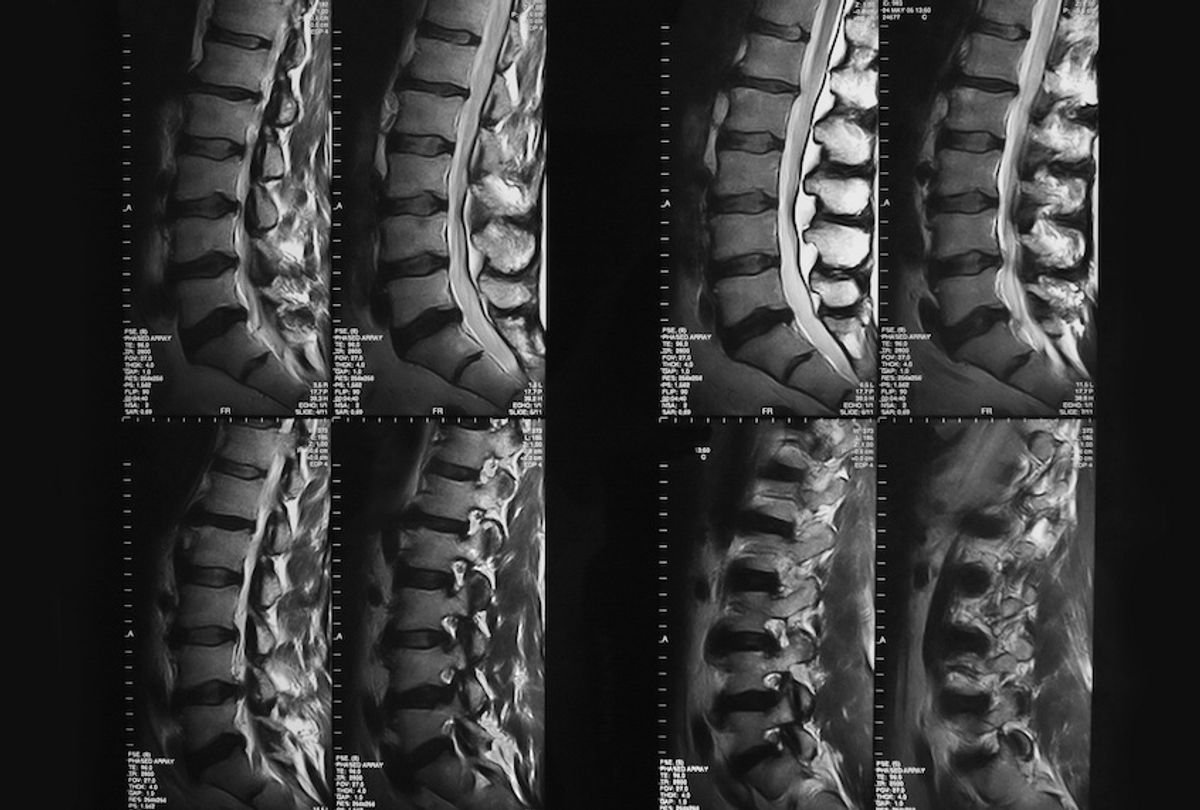 MRI of spinal column (Getty Images)