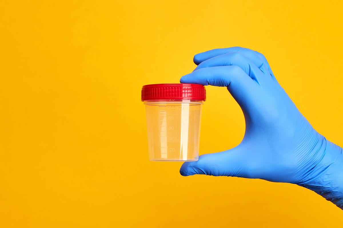 Medical examiner holding urine cup (Getty Images/Andrii Atanov)