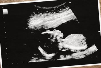 Ultrasound