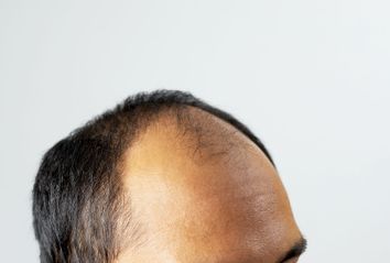 Close up man head of hair loss