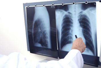 Chest X-Ray