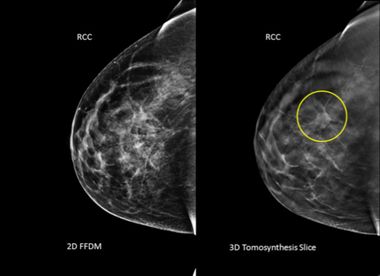 3D Mammograms