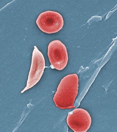 Gene Therapy Sickle Cell