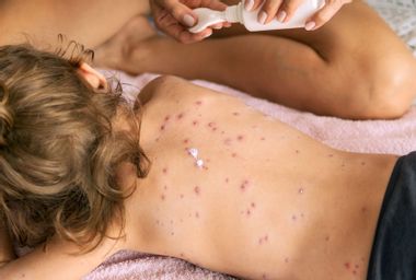Mother taking care of daughter with chicken pox.