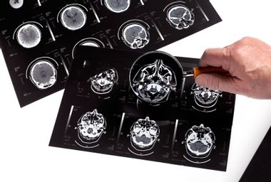 Dementia bran scan research