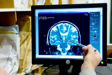 High Frequency Deep Brain Stimulation
