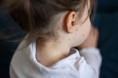 Girl with measles on their body