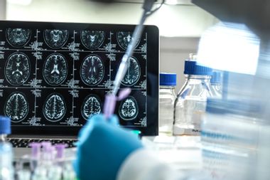 Image for New Alzheimer’s drug raises hopes — along with questions