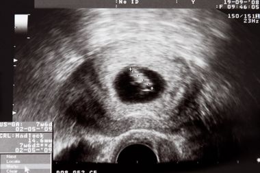 Two Texas judges face off on the ultrasound decision
