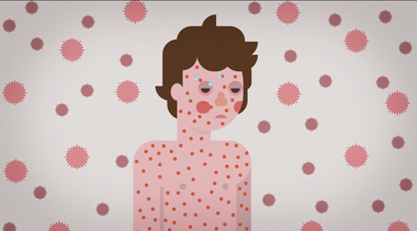Image for This is what the measles virus actually does to the body