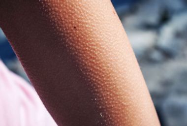 Goosebumps on a young woman's arm