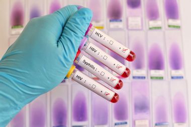 Sexually transmitted diseases infections HIV HBV HCV Syphilis tests vials
