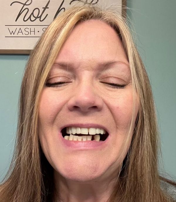 Carroll displays the dental implants she got in her upper jaw