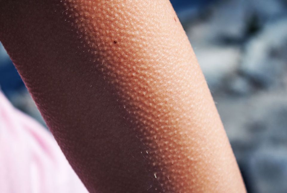 Goosebumps May Be A Side Effect Of Hair Follicle Muscles Scientists Say